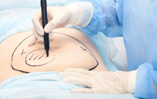 Liposuction of Stomach at Cosmetic Surgery Cyprus & Turkey