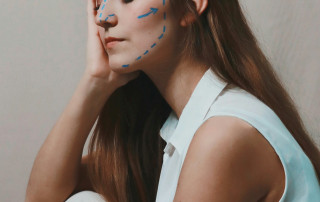 Facelift markings - cosmetic surgery cyprus and turkey