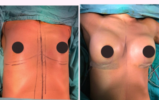 boob job before and after breast augmentation with cosmetic surgery cyprus