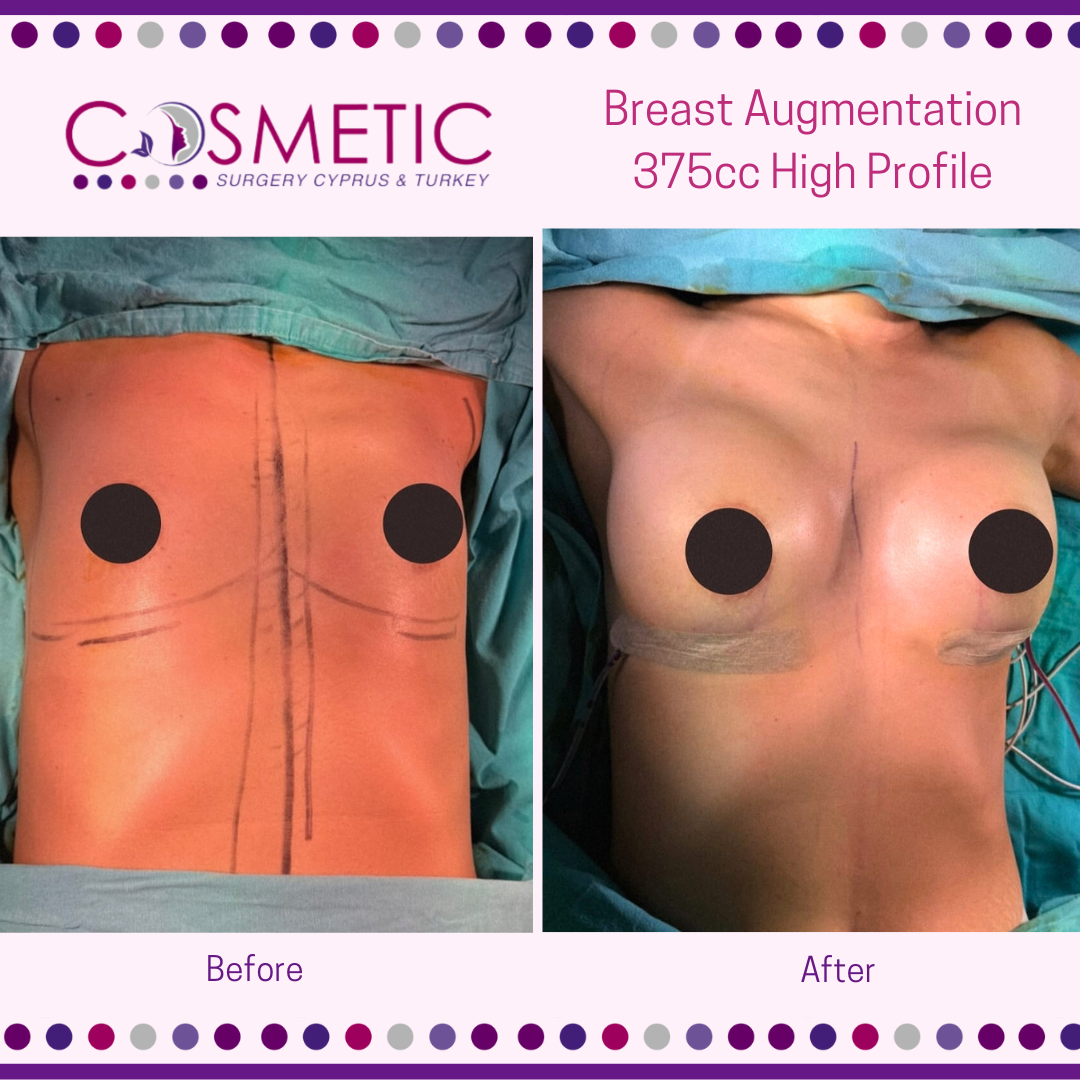 boob job before and after breast augmentation with cosmetic surgery cyprus