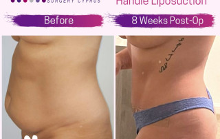 tummy tuck before and after with cosmetic surgery cyprus
