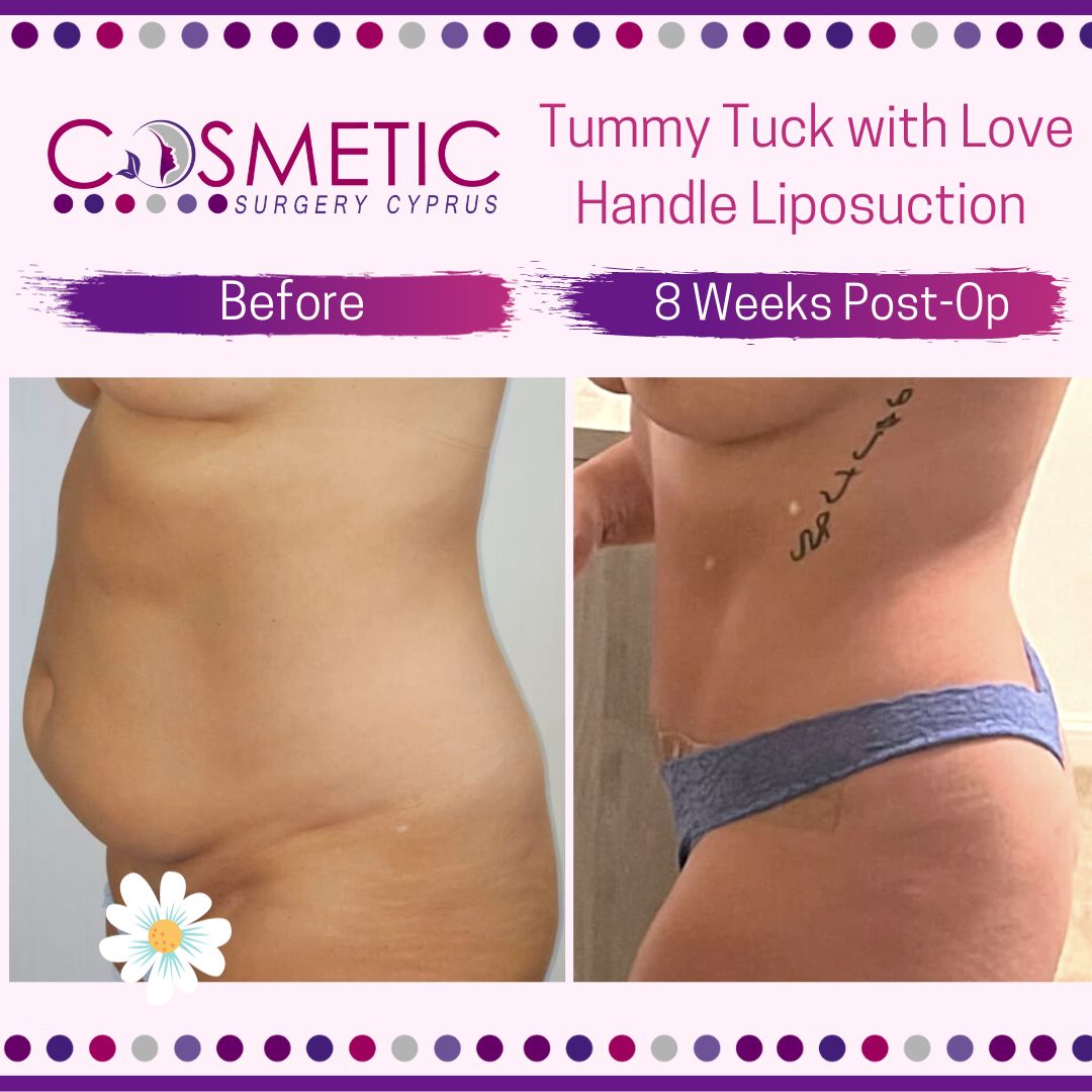 tummy tuck before and after with cosmetic surgery cyprus