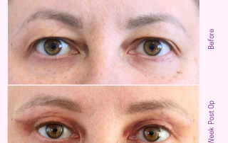 upper blepharoplasty eye lid lift at cosmetic surgery cyprus