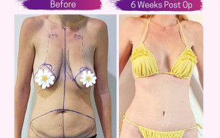 Mummy Makeover with Dr Bugra at Cosmetic Surgery Cyprus