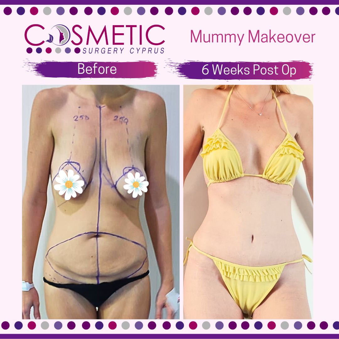 Mummy Makeover with Dr Bugra at Cosmetic Surgery Cyprus