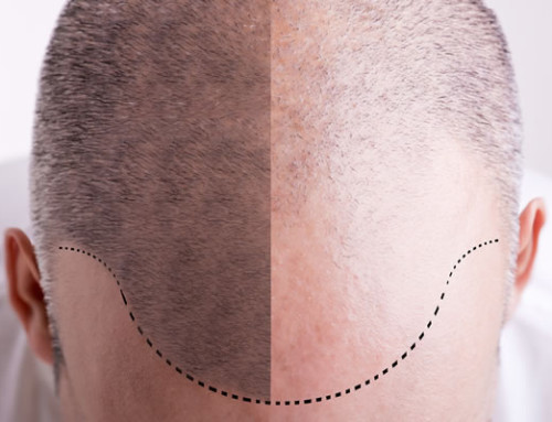 Hair Transplantation – An excellent option for millions of men and women
