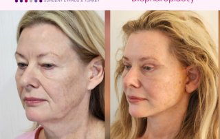 mini facelift at cosmetic surgery cyprus