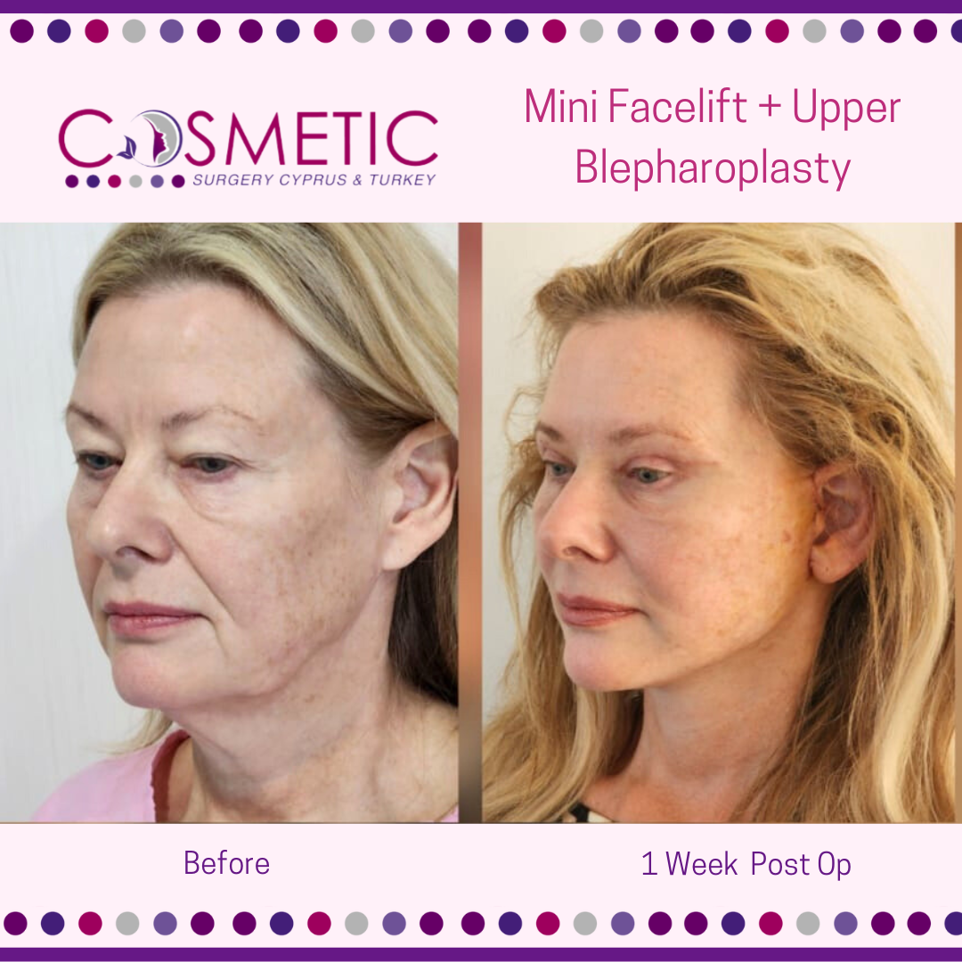 mini facelift at cosmetic surgery cyprus