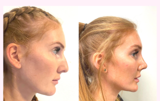 rhinoplasty cosmetic surgery cyprus