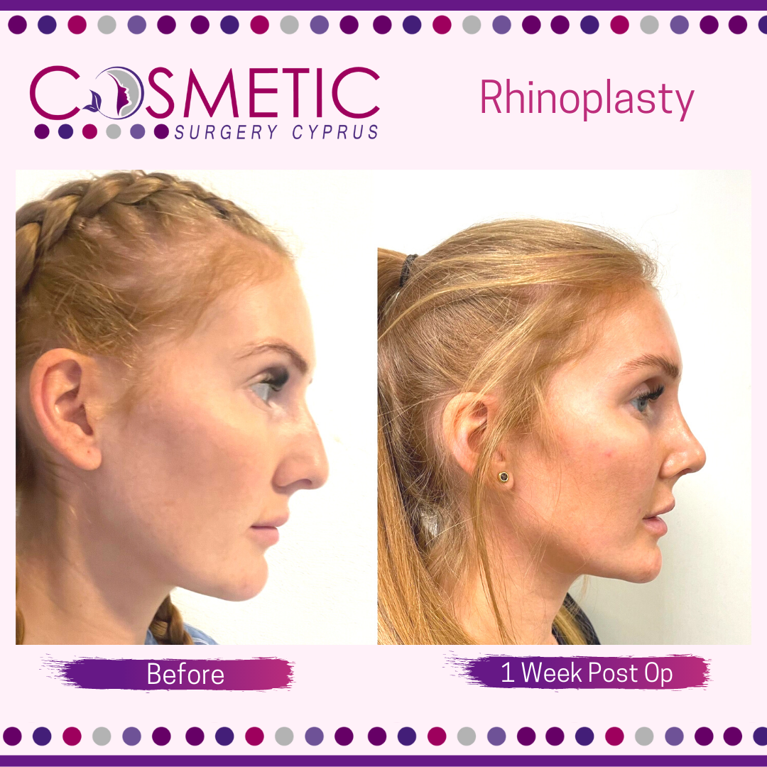 rhinoplasty cosmetic surgery cyprus
