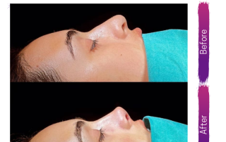 Ultrasonic Rhinoplasty before and after cosmetic surgery cyprus