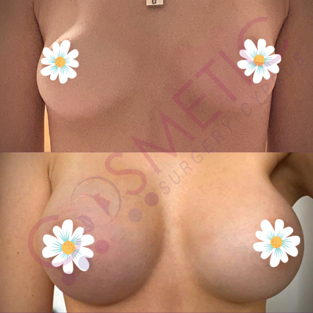 Breast Augmentation Cosmetic Surgery Cyprus