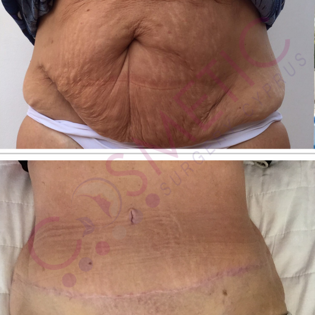 tummy tuck cosmetic surgery cyprus abdominoplasty in cyprus