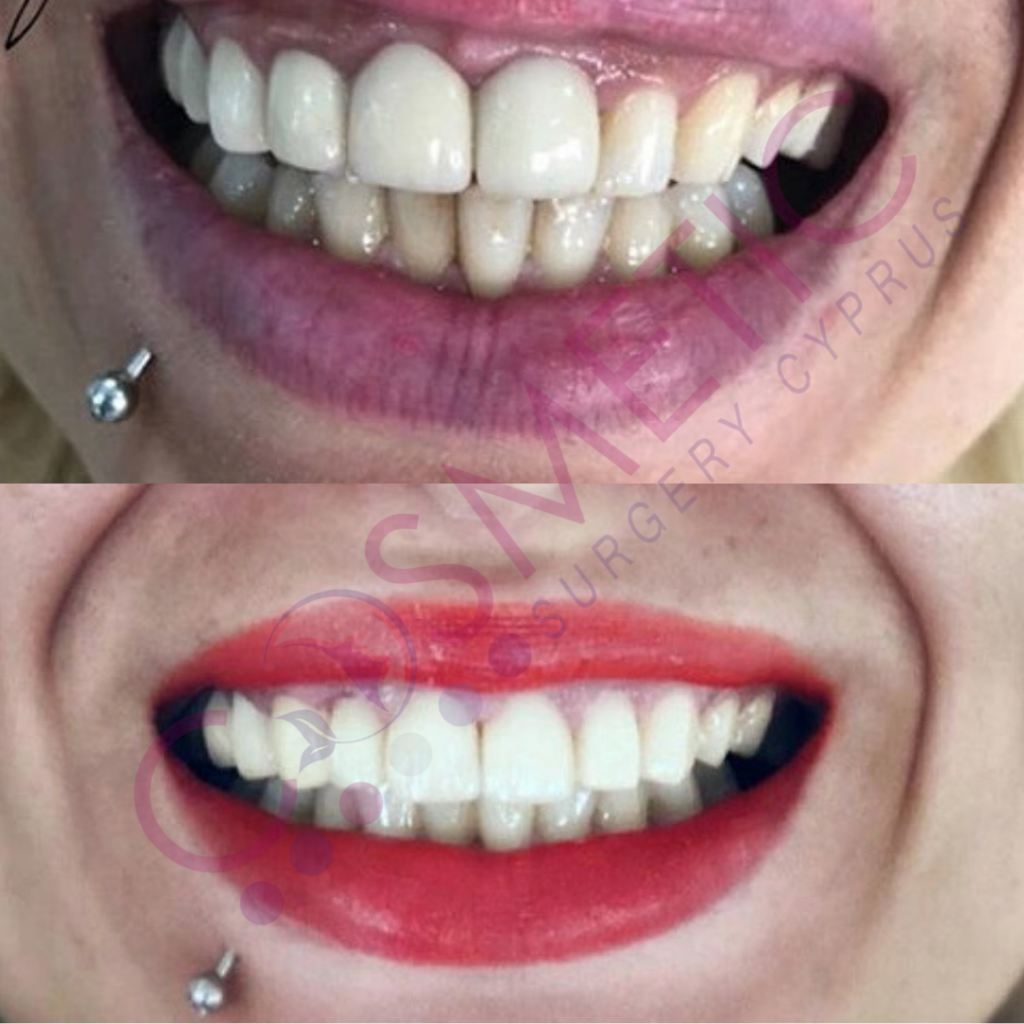 Dental Crowns Cosmetic Surgery Cyprus