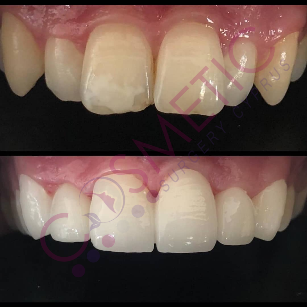 Dental Crowns Cosmetic Surgery Cyprus