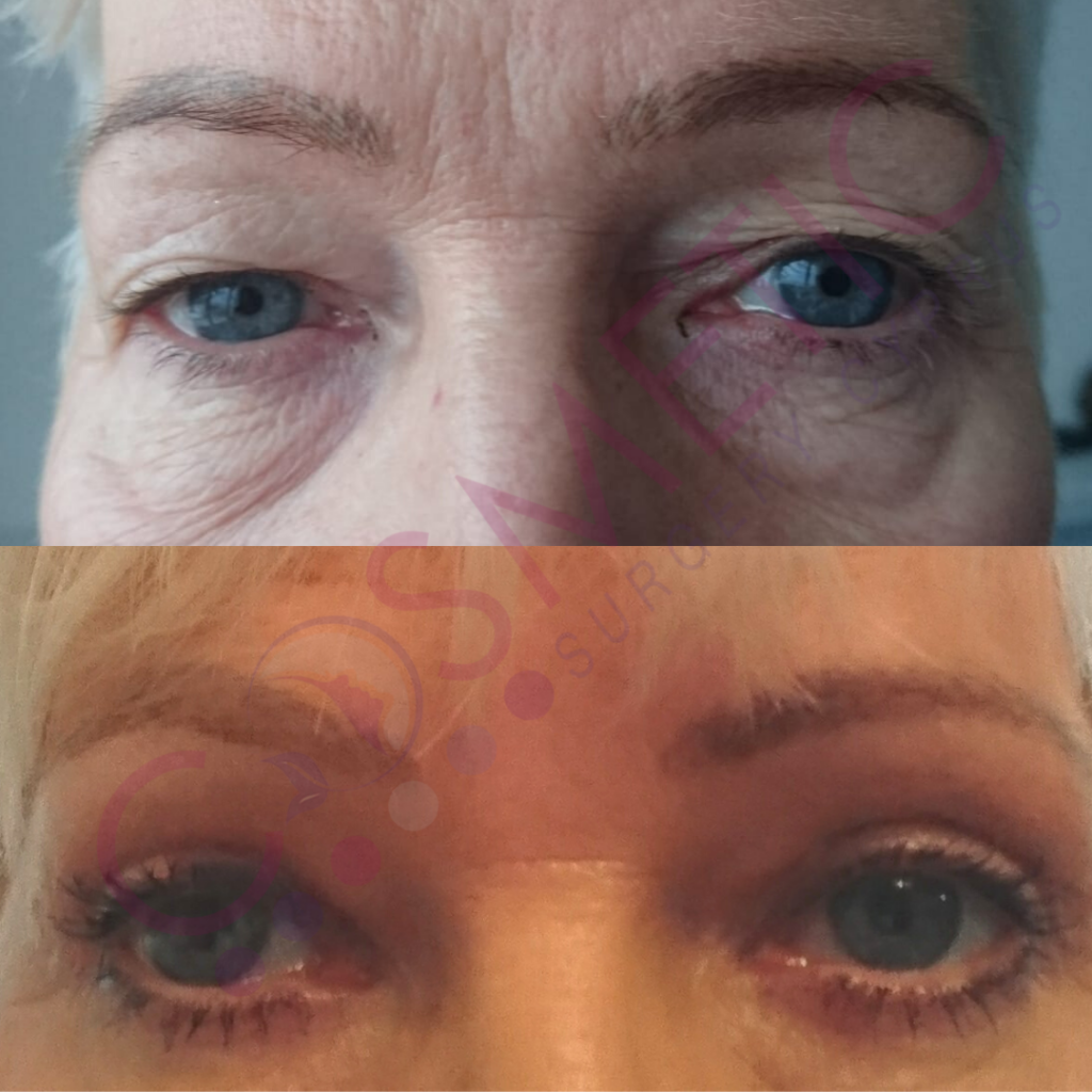 upper eyelid blepharoplasty cosmetic surgery cyprus