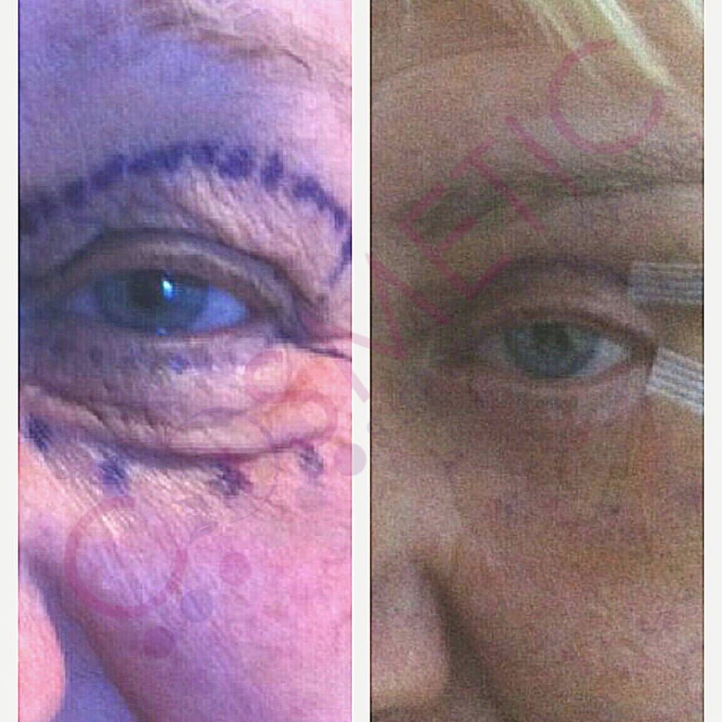 upper and lower eyelid blepharoplasty cosmetic surgery cyprus