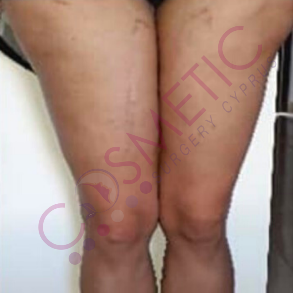 Thigh lift cosmetic surgery cyprus