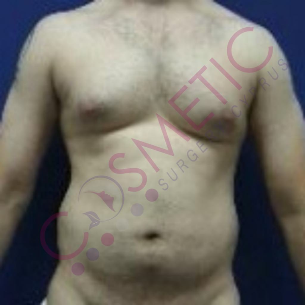 Male Liposuction Cosmetic Surgery Cyprus