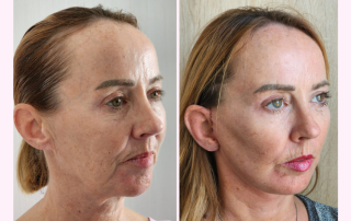 Facelift vs Mini Facelift in Cyprus & Turkey