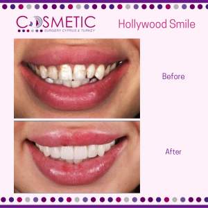 hollywood smile dental cosmetic surgery cyprus & turkey