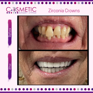zirconia crowns cosmetic surgery cyprus & turkey dentistry 