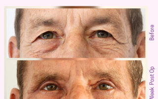upper blepharoplasty before and after example at cosmetic surgery cyprus turkey